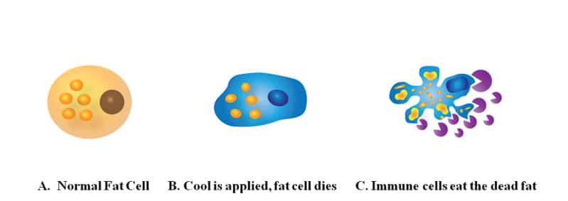 Cryolipolysis