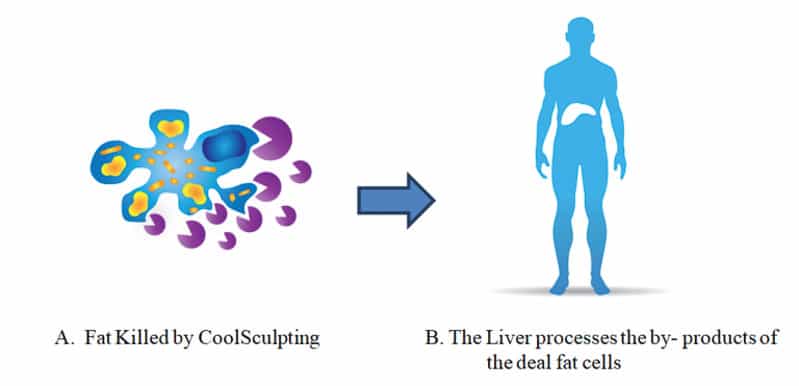 Fat killed by Coolsculpting