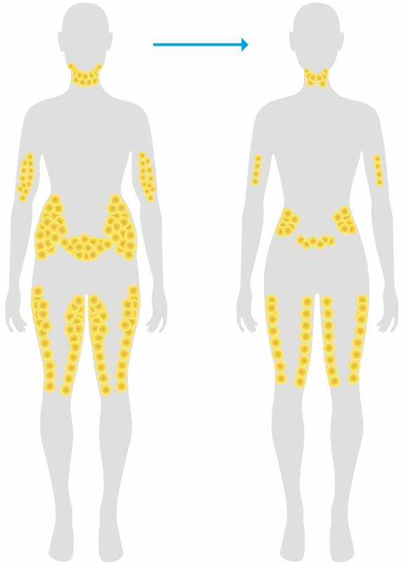 Best areas for coolsculpting