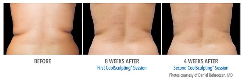 Coolsculpting before and after