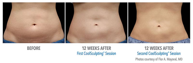 Coolsculpting before and after