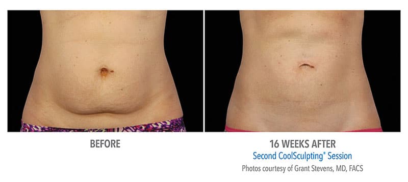 Coolsculpting before and after