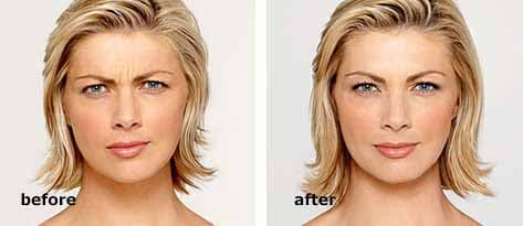 Botox before and after