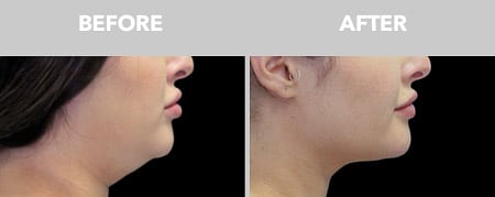 Fixing your double chin Fixing your double chin