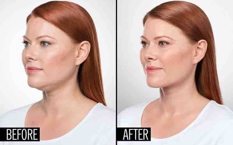 Belkyra before and after Belkyra before and after