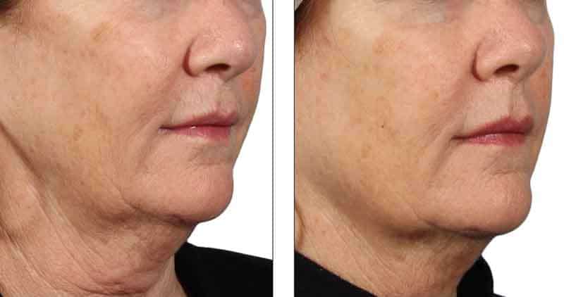 Venus Diamond Polar Facial Skin Tightening