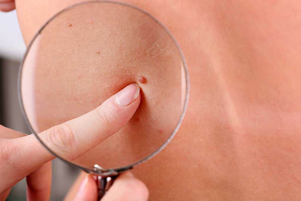 Moles and skin tags