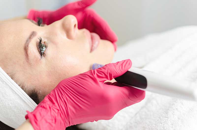 Microneedling