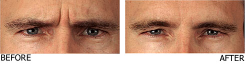 Botox male frown lines