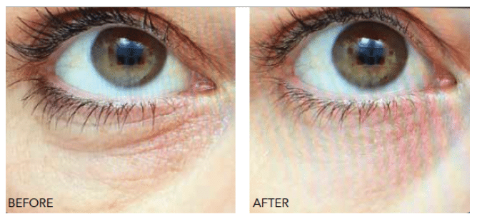 Blog-Wrinkle-free-eyes-at-every-age 40