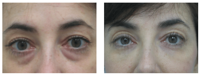 Blog-Wrinkle-free-eyes-at-every-age-Google-50