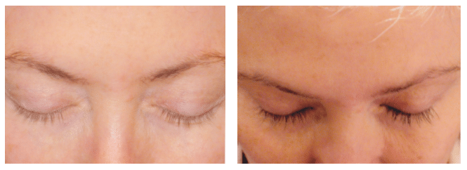 Blog-Wrinkle-free-eyes-at-every-age-Google-60 Latisse