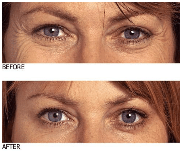 Blog-Wrinkle-free-eyes-at-every-age