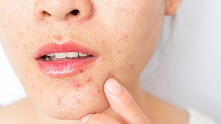 Adult Acne from mask