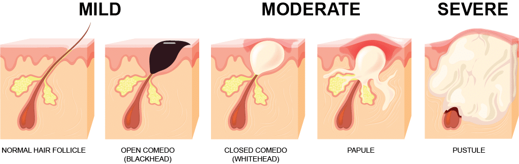 Acne Stages