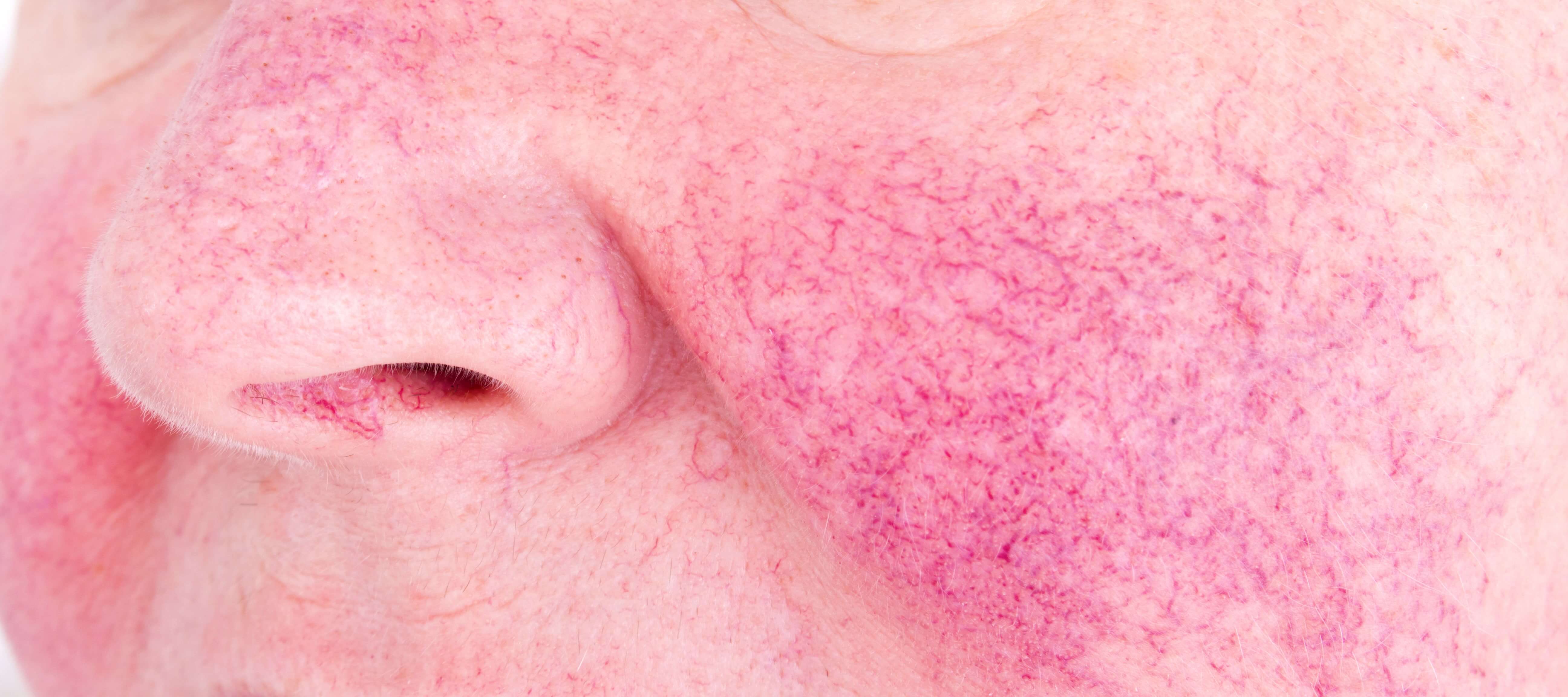 Rosacea Treatment options