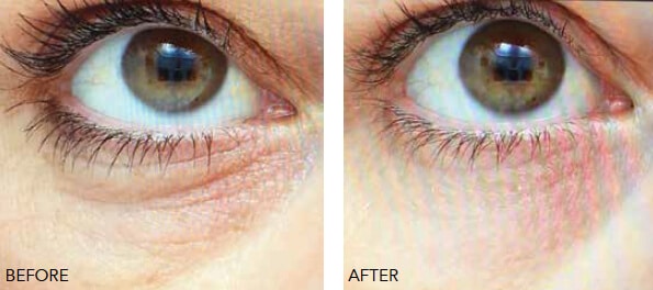 V2-BA-LowerEyelid (1) Beauty Booster Results Mississauga