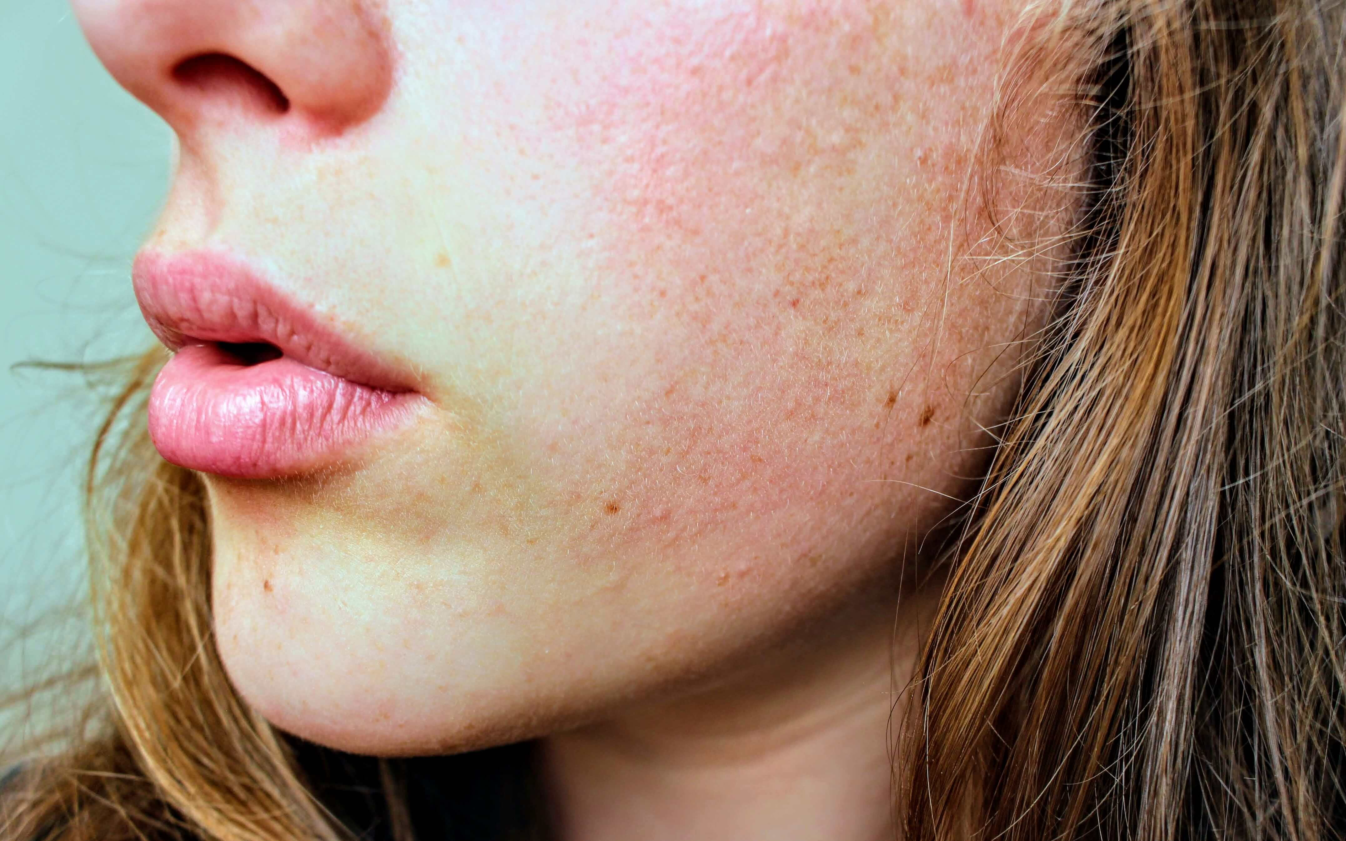 Rosacea on face