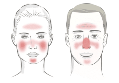 Rosacea Treatment Zones