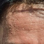 sweat-excess Excessive Sweating