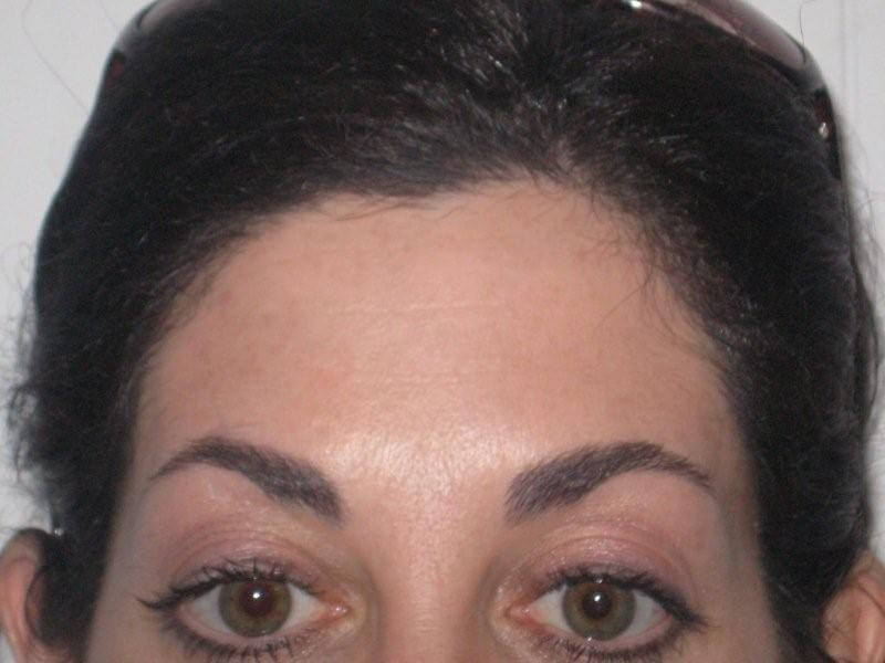 After Botox Treatment