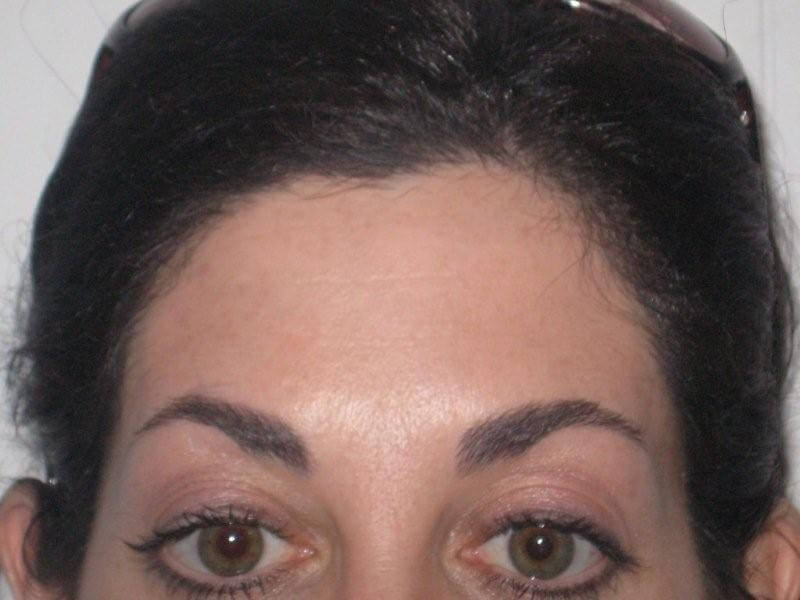After Botox Treatment copy (1) After Botox Treatment