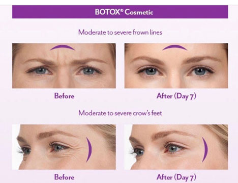 Botox Before & After