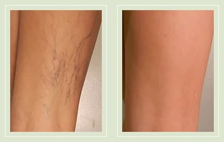 VTC-BEFORE-AFTER-AB-min VTC Before and After