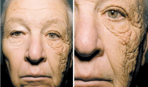 man with sun damage on face