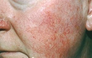 rosacea-symptoms_ETR