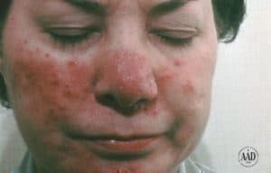 rosacea_landing