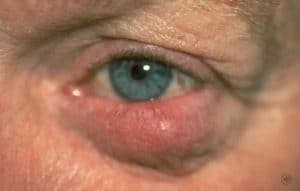 rosacea_symptoms-ocular