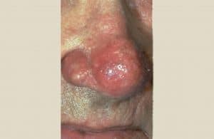 rosacea_symptoms_rhynophyma