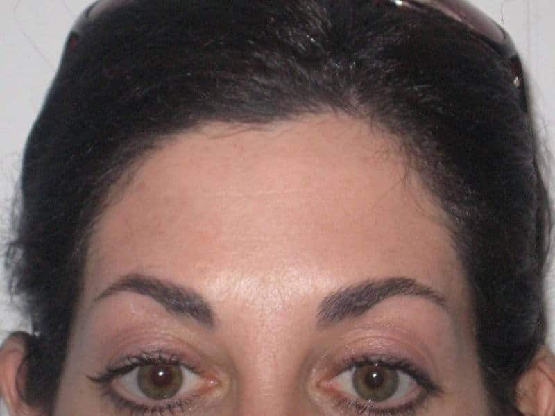 After Botox Treatment-edit (1) After Botox