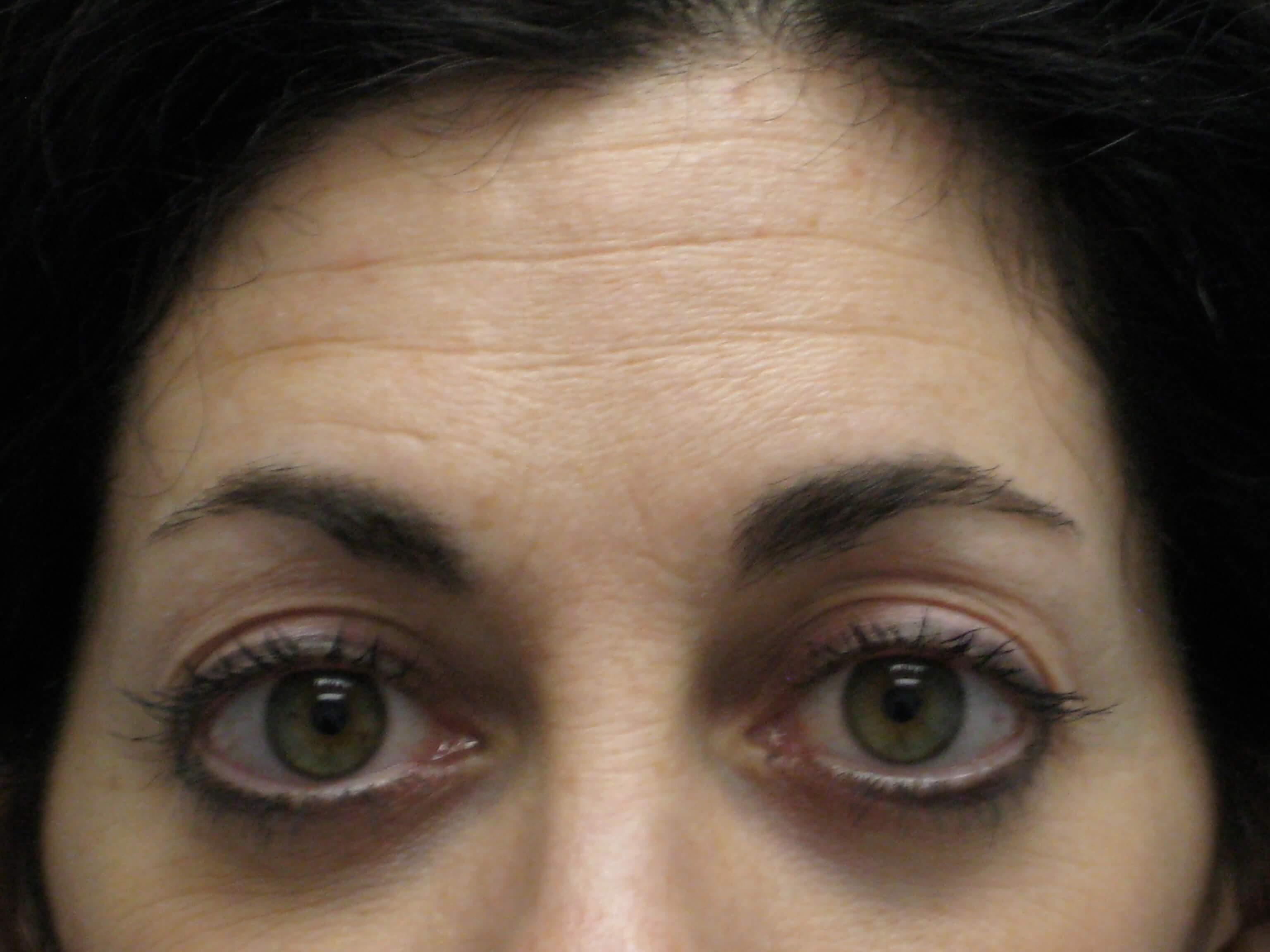 Before Botox Treatment before-edit Before Botox