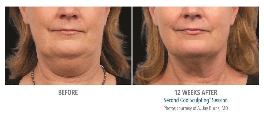 Double Chin B & A DoublechinB-A