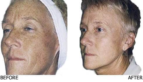IPL-for-Severe-Sun-Damage-Face-4 (1) IPL Before and After