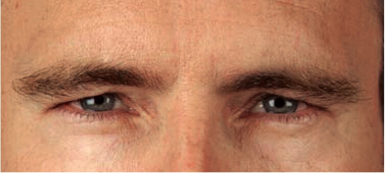 MaleFrownLines_Aftr MaleFrownLines_Aftr