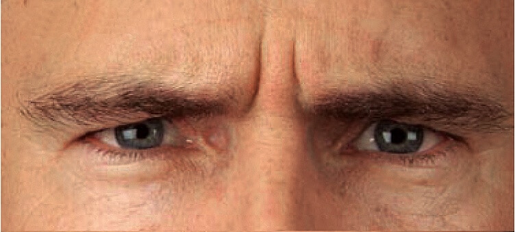 MaleFrownLines_Bfor MaleFrownLines_Bfor
