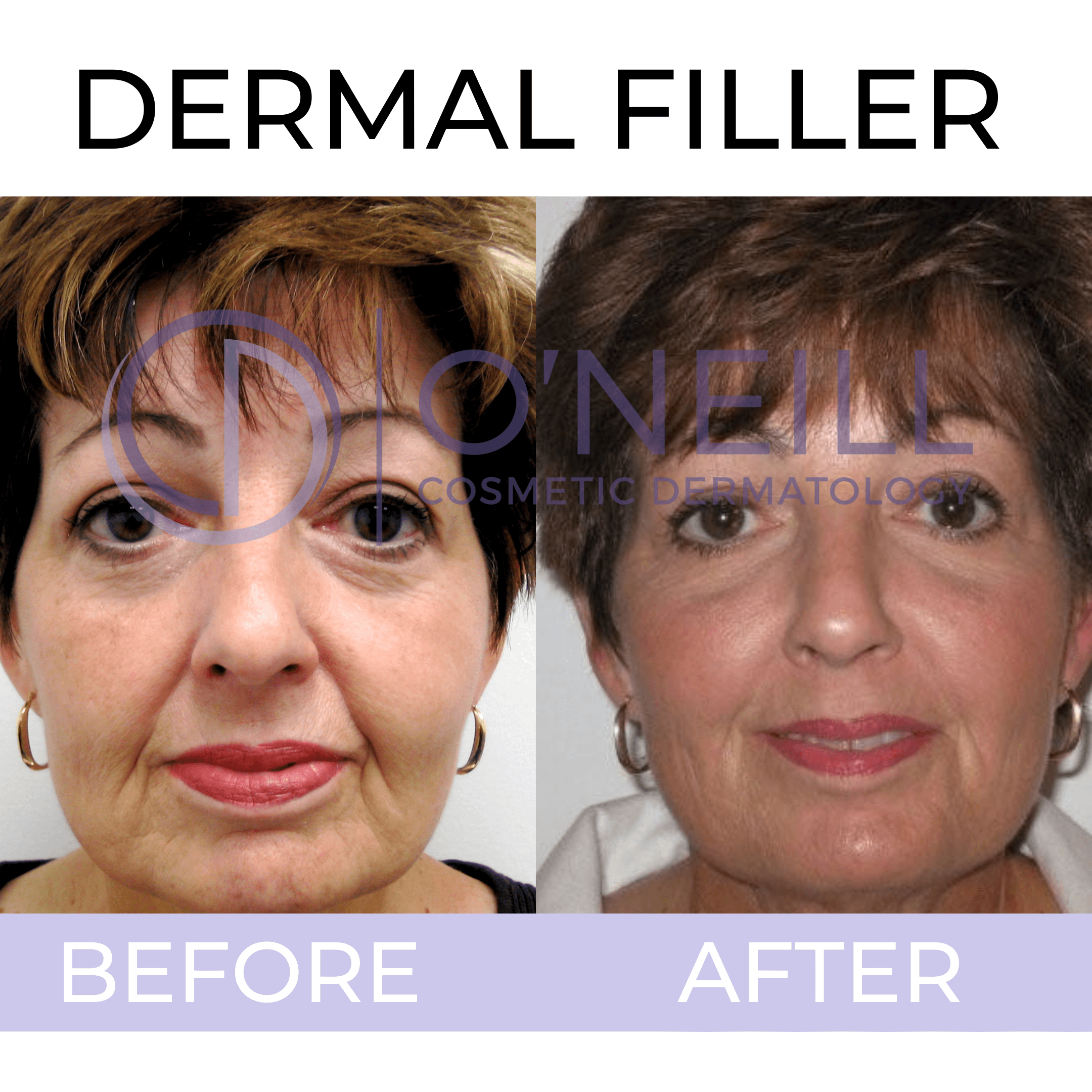 Dermal-Filler-Before-and-After Before and After
