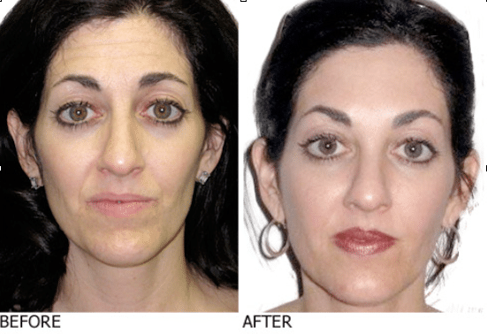 Lip-filler-and-dermal-filler-injections Michele before & after