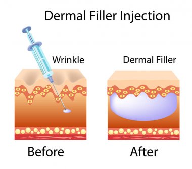 Dermal filler injection