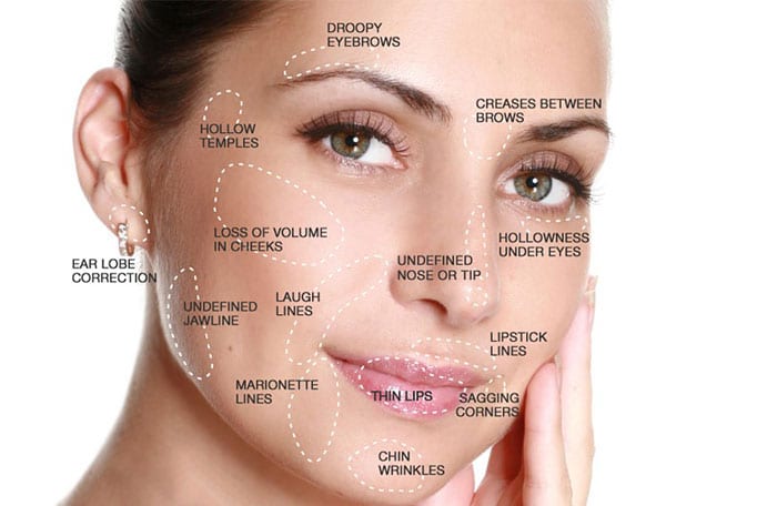 Dermal fillers face map