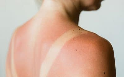 How to Treat a Sunburn