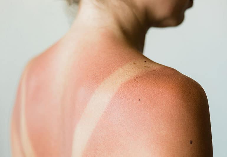 Sunburn at the back of a woman's body