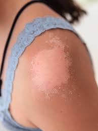 skin peeling on shoulder